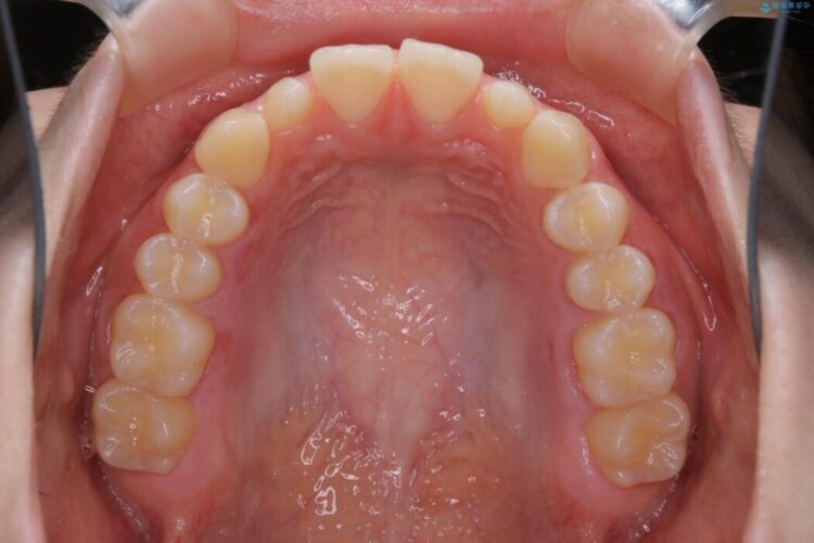 【10代女性】生まれつき小さい歯をセラミックで補綴しすきっ歯を改善する 治療前画像