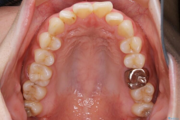 【20代女性】非抜歯で口ゴボ改善するインビザライン矯正治療 治療前画像
