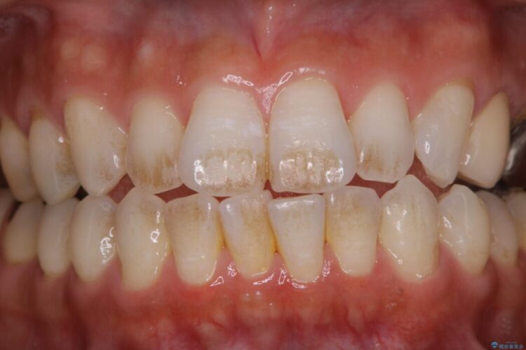 【30代男性】1年ぶりのクリーニング(コーヒーによる着色落とし) 治療前画像