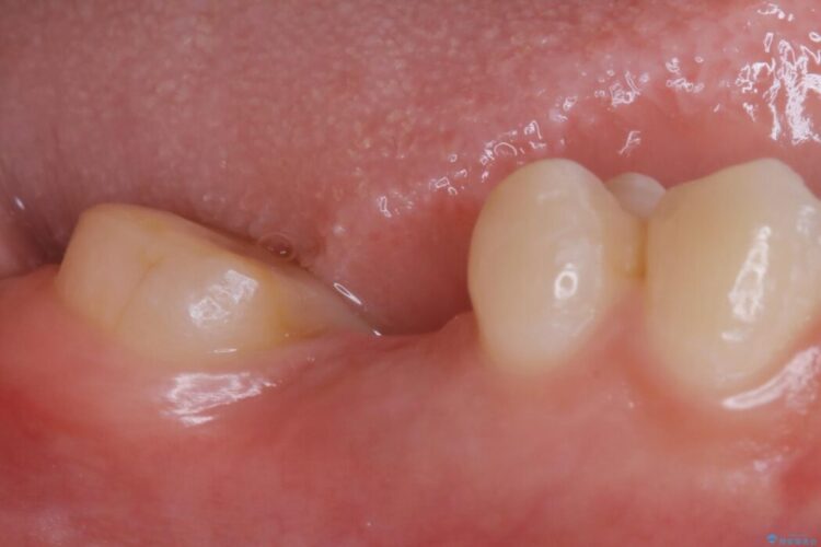 【20代女性】傾斜してしまった奥歯の部分矯正を併用したブリッジ治療 治療前画像