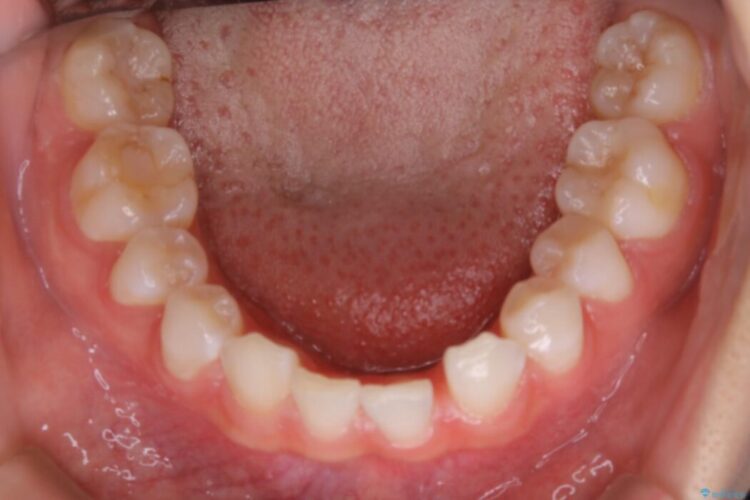 【20代女性】生まれつき歯の本数が足りない先天欠如を治療する 治療前画像