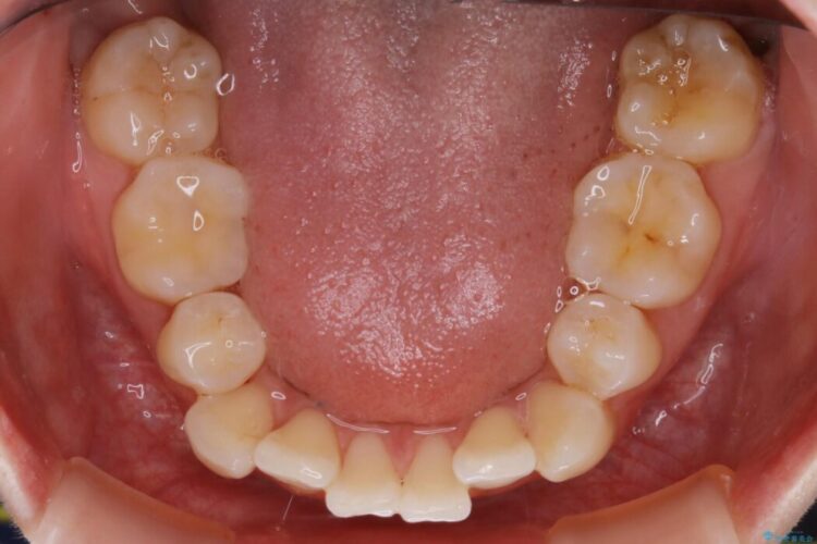 【20代女性】10代の頃にした矯正の後戻りを再矯正する 治療前画像