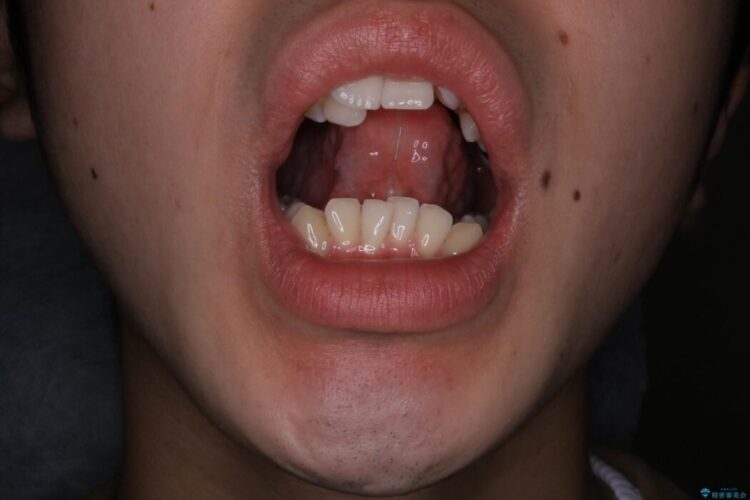 【20代男性】矯正治療前に舌小帯切除で滑舌の改善 治療前画像