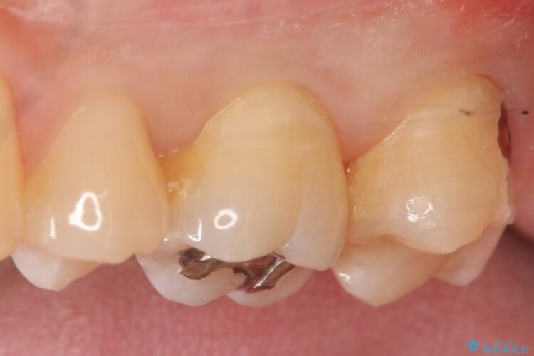 【20代男性】深い虫歯を長持ちするゴールドインレーで治療 治療前画像