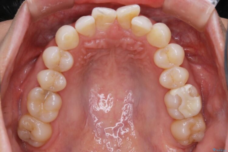 【30代女性】歯根破折と歯列矯正の治療で噛み合わせを改善 治療前画像