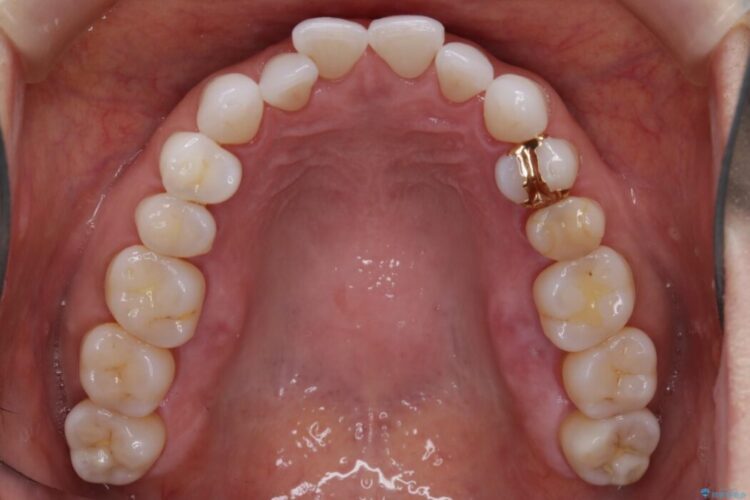 【40代女性】開咬(オープンバイト)の非抜歯インビザライン矯正治療 治療前画像