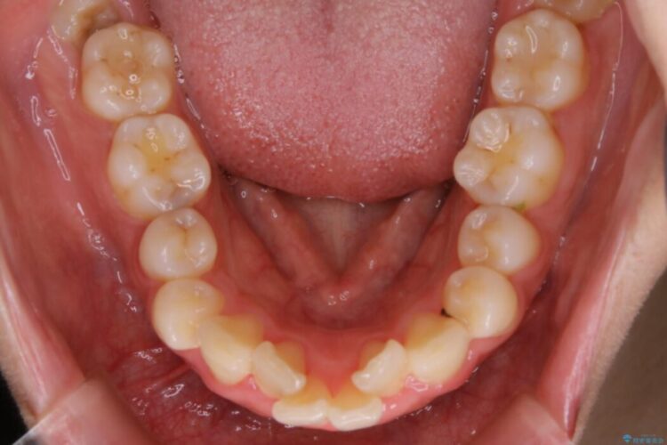 【20代女性】非抜歯で口ゴボ改善するインビザライン矯正治療 治療前画像