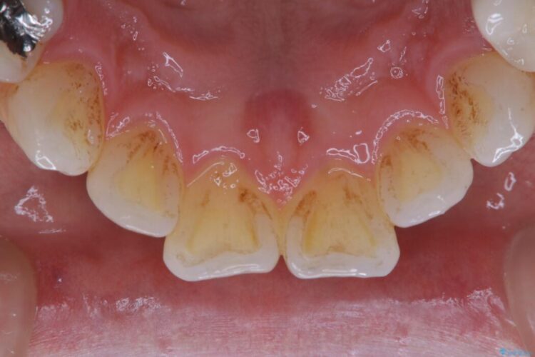 【30代男性】1年ぶりのクリーニング(コーヒーによる着色落とし) 治療前画像