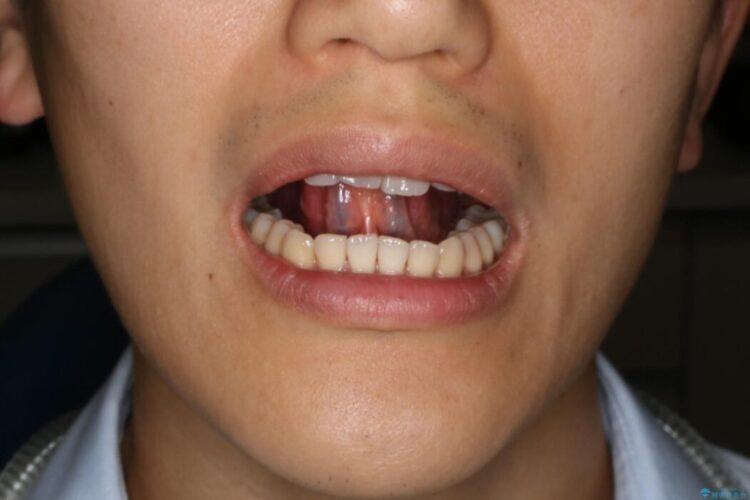 【20代男性】滑舌の悪さを改善したい！舌小帯切除術 治療前画像