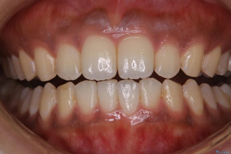 【20代女性】タバコのヤニ（ニコチン、タール）を徹底的に除去 治療前画像