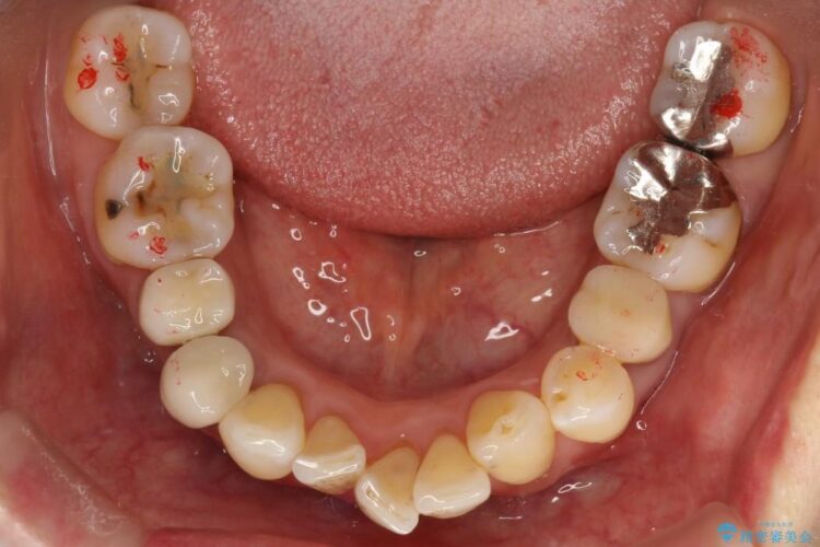 【50代女性】八重歯のインビザライン矯正 治療例 治療前画像