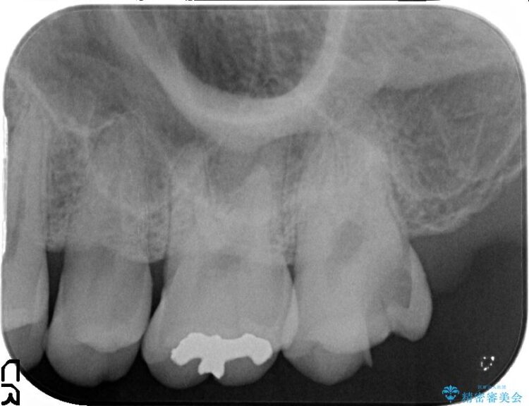 【20代男性】深い虫歯を長持ちするゴールドインレーで治療 治療前画像
