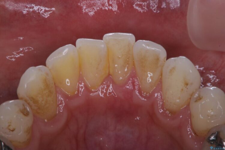 【30代男性】1年ぶりのクリーニング(コーヒーによる着色落とし) 治療前画像