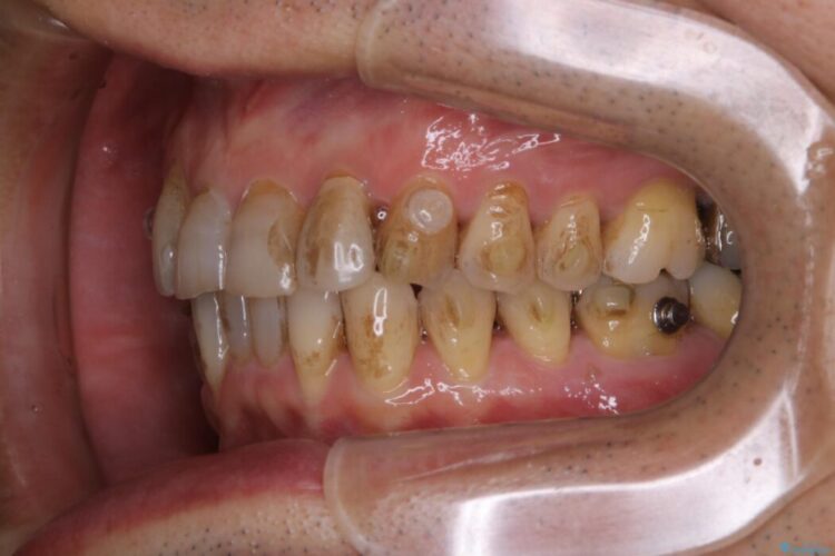 【40代男性】インビザライン治療中の頑固な着色落としをクリーニング 治療前画像