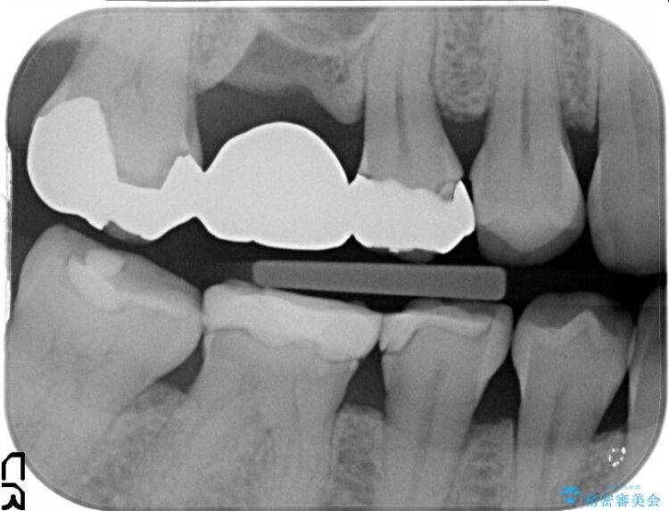 【40代女性】古い不適合な詰め物をセラミックインレーで再治療 治療前画像