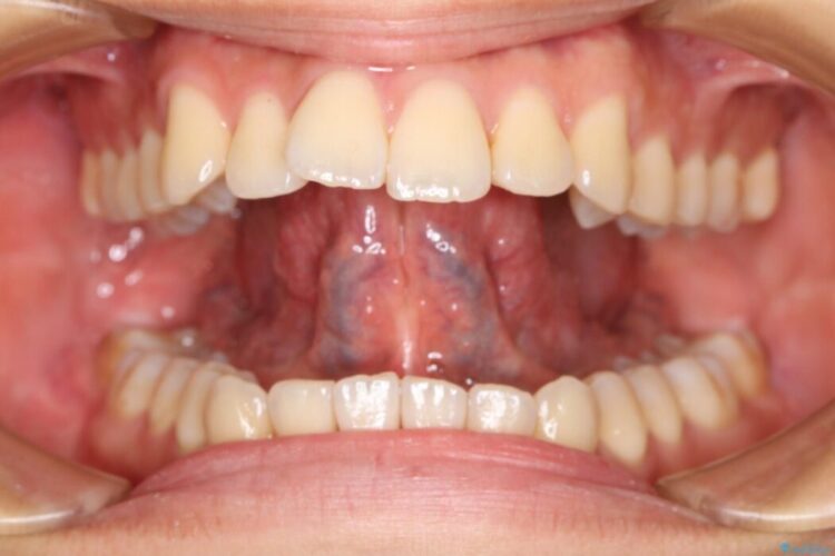 【20代男性】滑舌の悪さを改善したい！舌小帯切除術 治療前画像