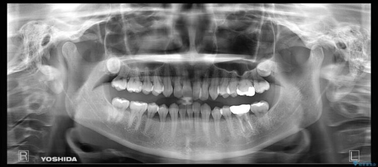 【30代女性】歯根破折と歯列矯正の治療で噛み合わせを改善 治療前画像