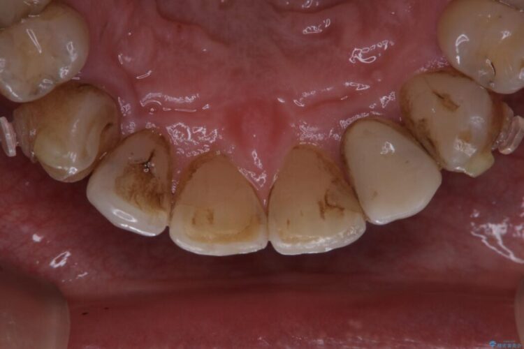 【40代男性】インビザライン治療中の頑固な着色落としをクリーニング 治療前画像