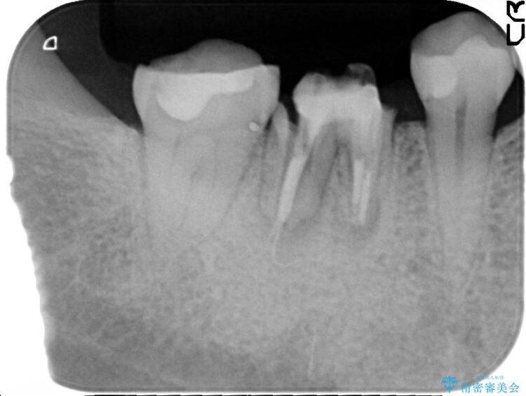 【30代女性】右下奥歯のインプラント 治療例 治療前画像