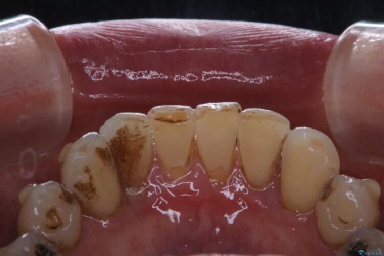 【40代男性】インビザライン治療中の頑固な着色落としをクリーニング 治療前画像