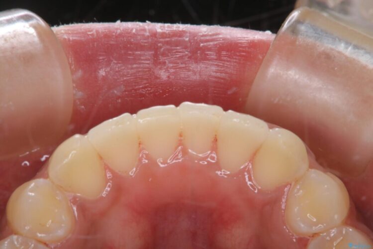 【20代女性】タバコのヤニ（ニコチン、タール）を徹底的に除去 治療後画像