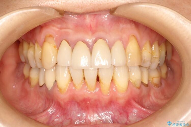 【50代女性】八重歯のインビザライン矯正 治療例 アフター