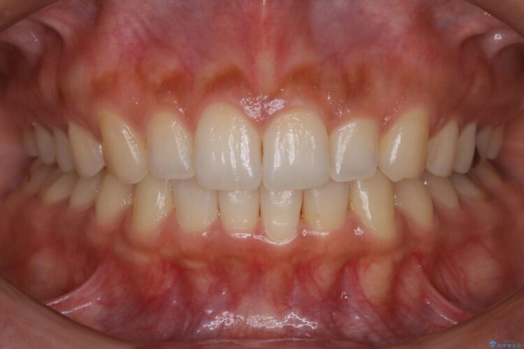 【30代女性】ガタつきのある狭窄歯列を改善する 治療後画像