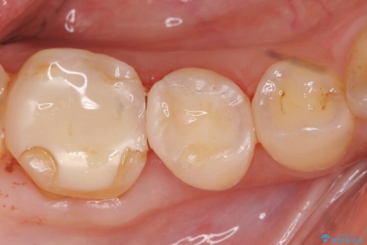 【40代女性】古い不適合な詰め物をセラミックインレーで再治療 治療後画像