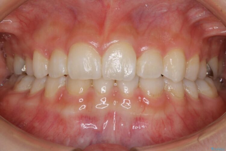 【20代女性】生まれつき歯の本数が足りない先天欠如を治療する 治療後画像