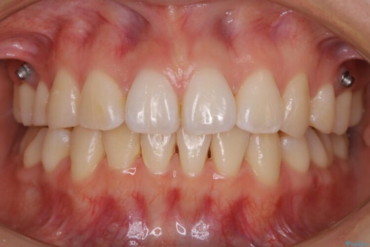 【20代女性】10代の頃にした矯正の後戻りを再矯正する 治療後画像