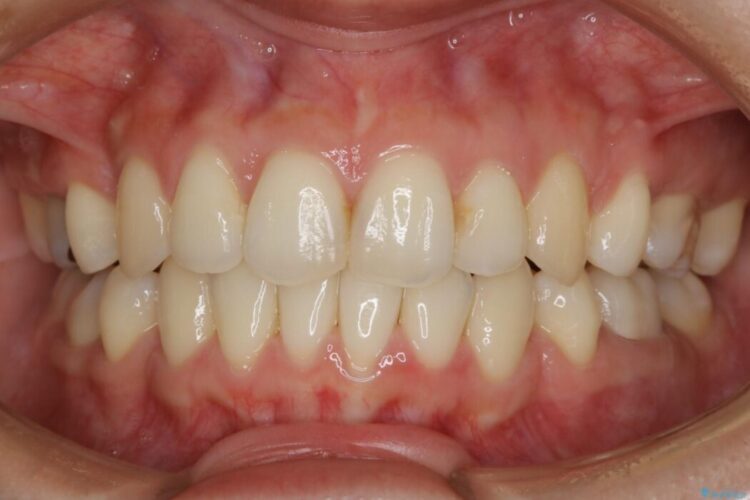 【20代女性】抜歯矯正で叢生をなおす 治療後画像