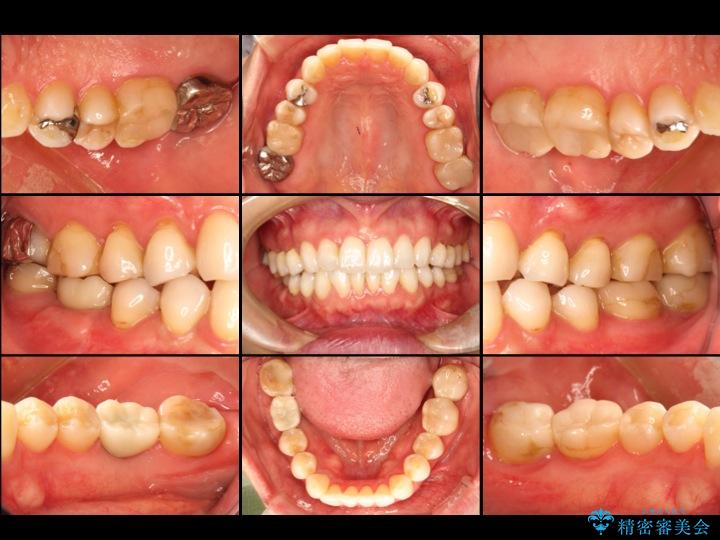 【30代女性】右下奥歯のインプラント 治療例 アフター
