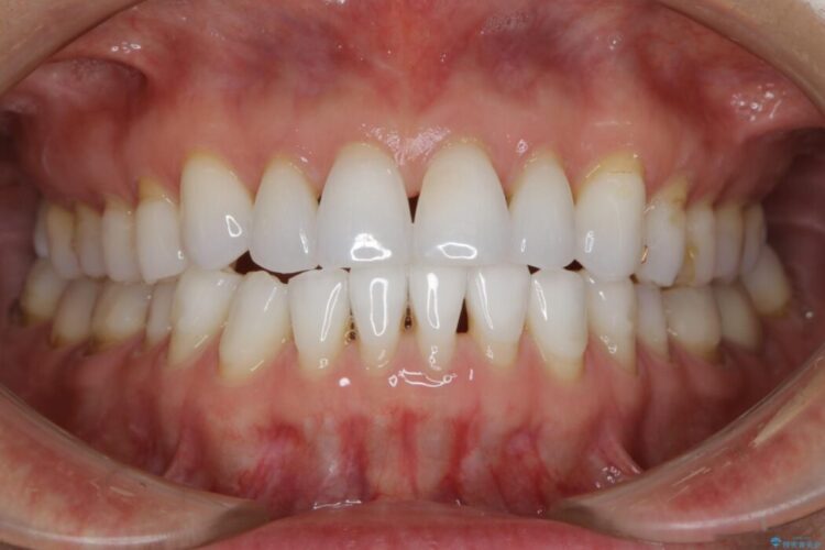【40代女性】開咬(オープンバイト)の非抜歯インビザライン矯正治療 治療後画像