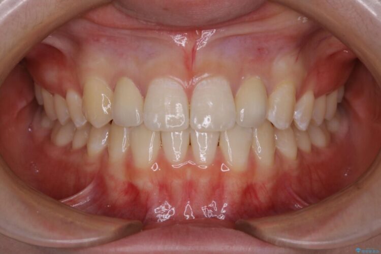 【10代女性】生まれつき小さい歯をセラミックで補綴しすきっ歯を改善する 治療後画像