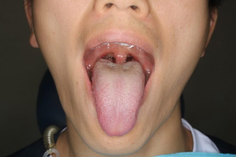 【20代男性】滑舌の悪さを改善したい！舌小帯切除術 治療後画像