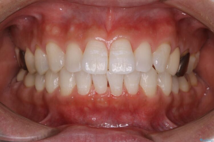 【30代男性】1年ぶりのクリーニング(コーヒーによる着色落とし) アフター