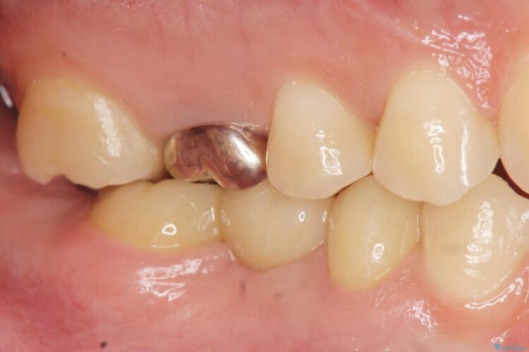 【20代女性】傾斜してしまった奥歯の部分矯正を併用したブリッジ治療 治療後画像