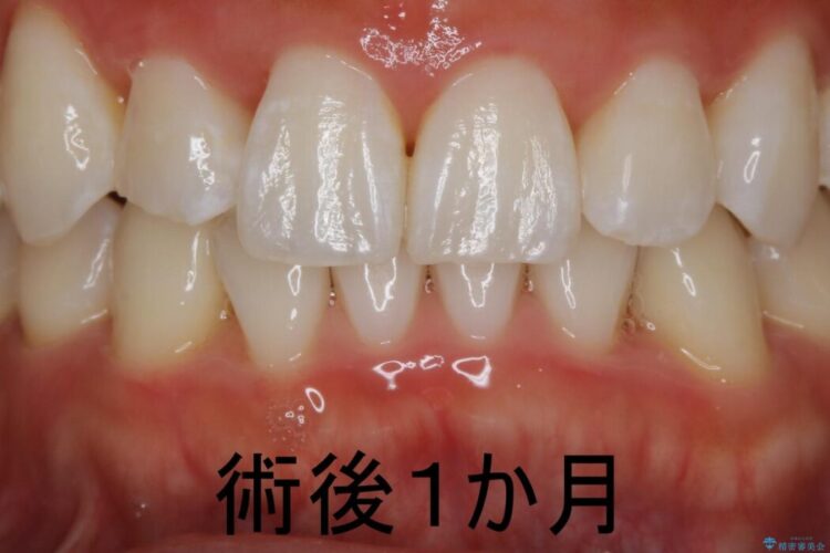 【30代男性】歯肉のブラックトライアングル治療 治療後画像
