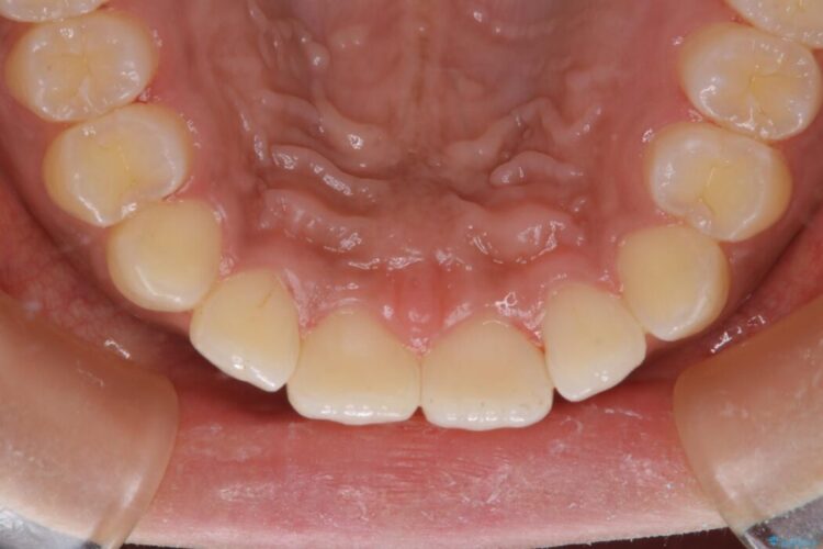 【20代女性】タバコのヤニ（ニコチン、タール）を徹底的に除去 治療後画像