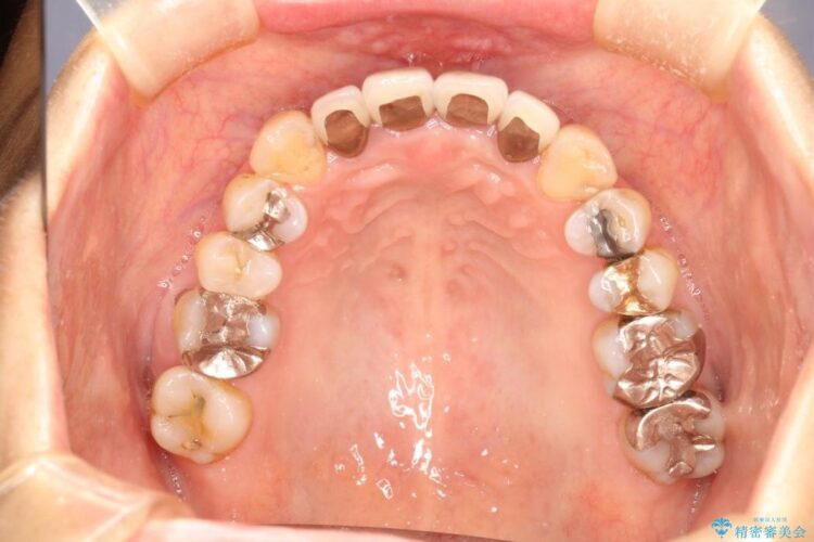 【50代女性】八重歯のインビザライン矯正 治療例 治療後画像