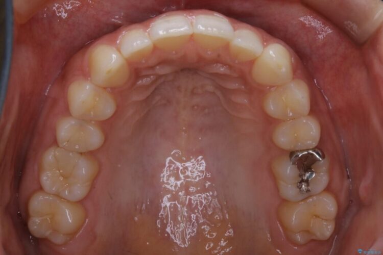 【30代女性】ガタつきのある狭窄歯列を改善する 治療後画像