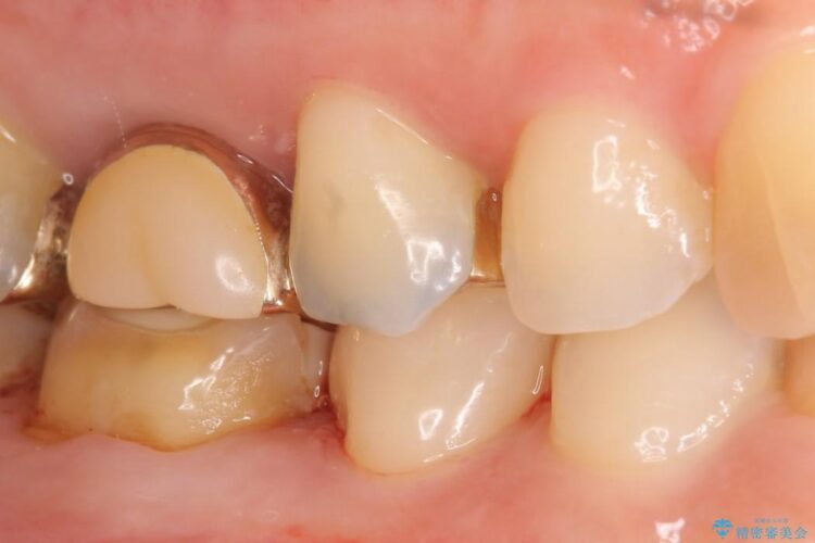 【40代女性】古い不適合な詰め物をセラミックインレーで再治療 治療後画像