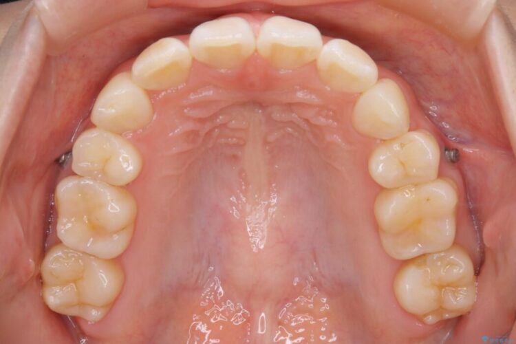 【20代女性】10代の頃にした矯正の後戻りを再矯正する 治療後画像