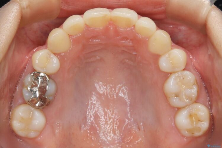 【20代女性】抜歯矯正で叢生をなおす 治療後画像