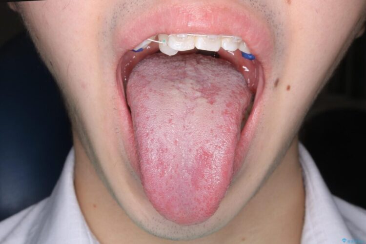 【20代男性】矯正治療前に舌小帯切除で滑舌の改善 アフター