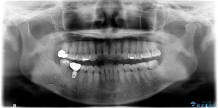 【30代女性】右下奥歯のインプラント 治療例 治療後画像