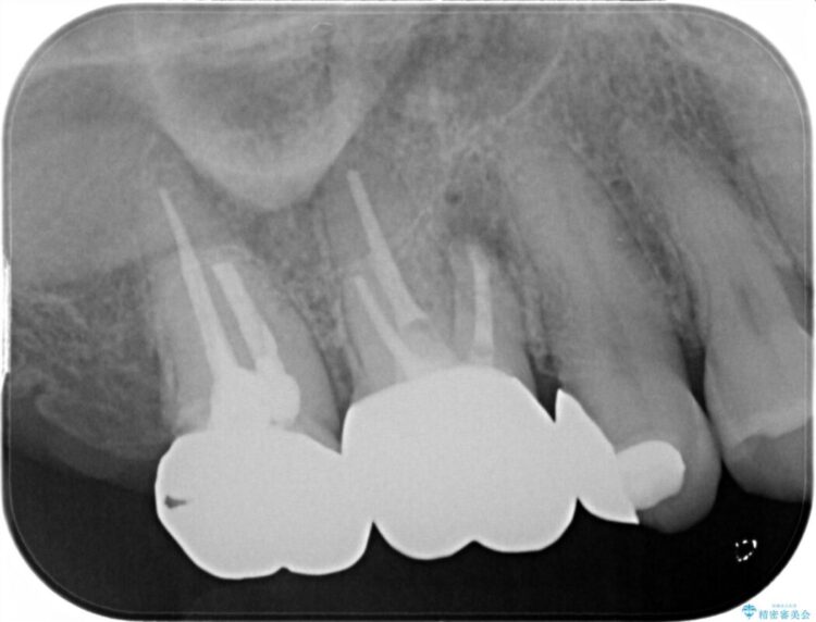 【40代女性】繰り返しニキビのようなものができる 治療後画像