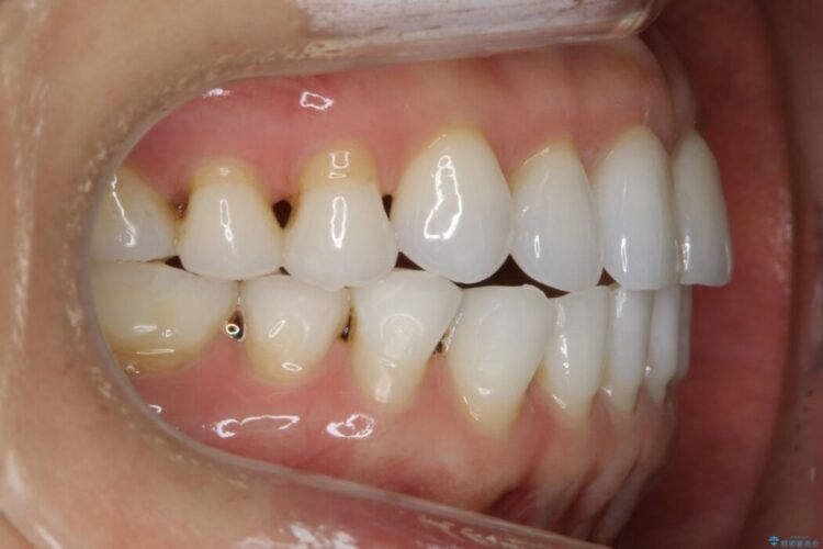 【40代女性】開咬(オープンバイト)の非抜歯インビザライン矯正治療 治療後画像