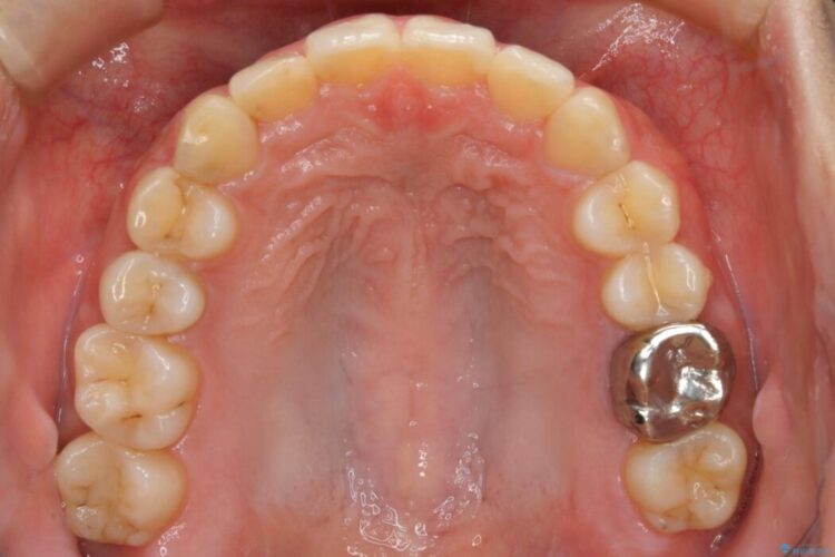 【20代女性】非抜歯で口ゴボ改善するインビザライン矯正治療 治療後画像