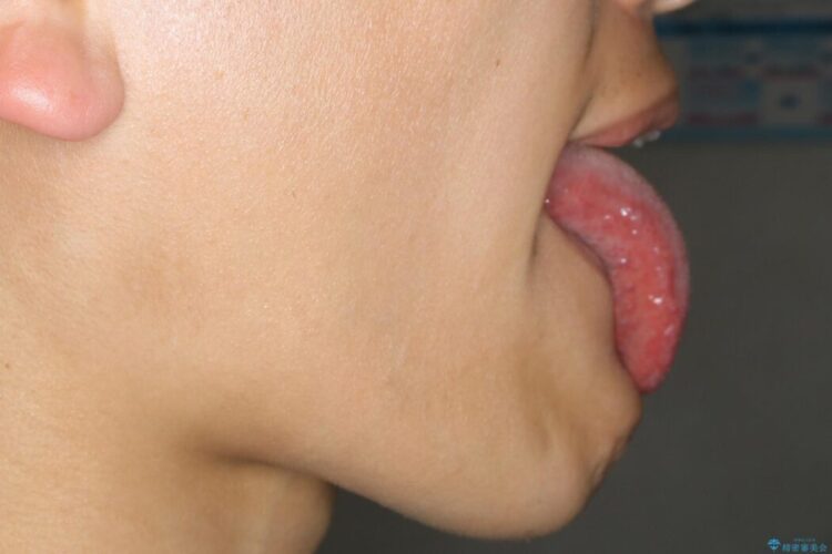 【20代男性】滑舌の悪さを改善したい！舌小帯切除術 治療後画像